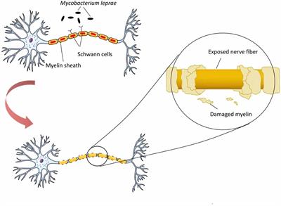 Microorganisms’ Footprint in Neurodegenerative Diseases